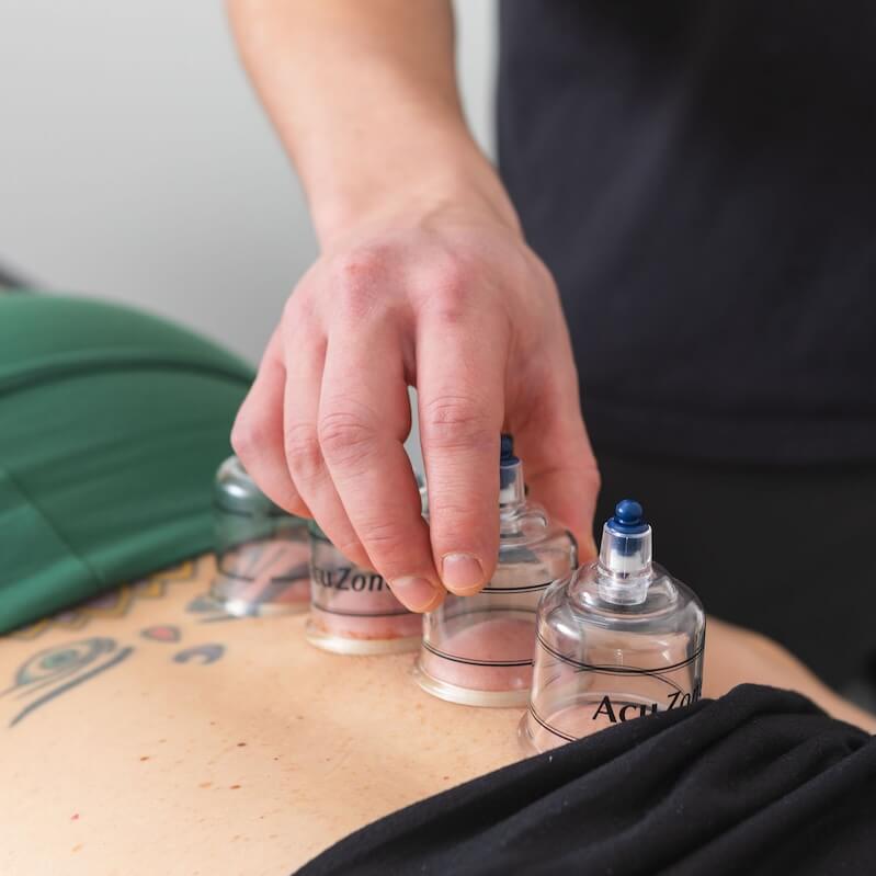 Adam-Cupping-Accupuncture (1) Adam Gawlak using hard cups for cupping to treat a lower back injury for a dancer in portland, oregon at Prime Perforamnce